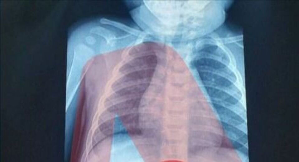 Αθήνα:-Απίστευτο-αυτό-που-είδαν-οι-γιατροί-στην-ακτινογραφία-του-3χρονου!-Είχε-στο-στομάχι-του…